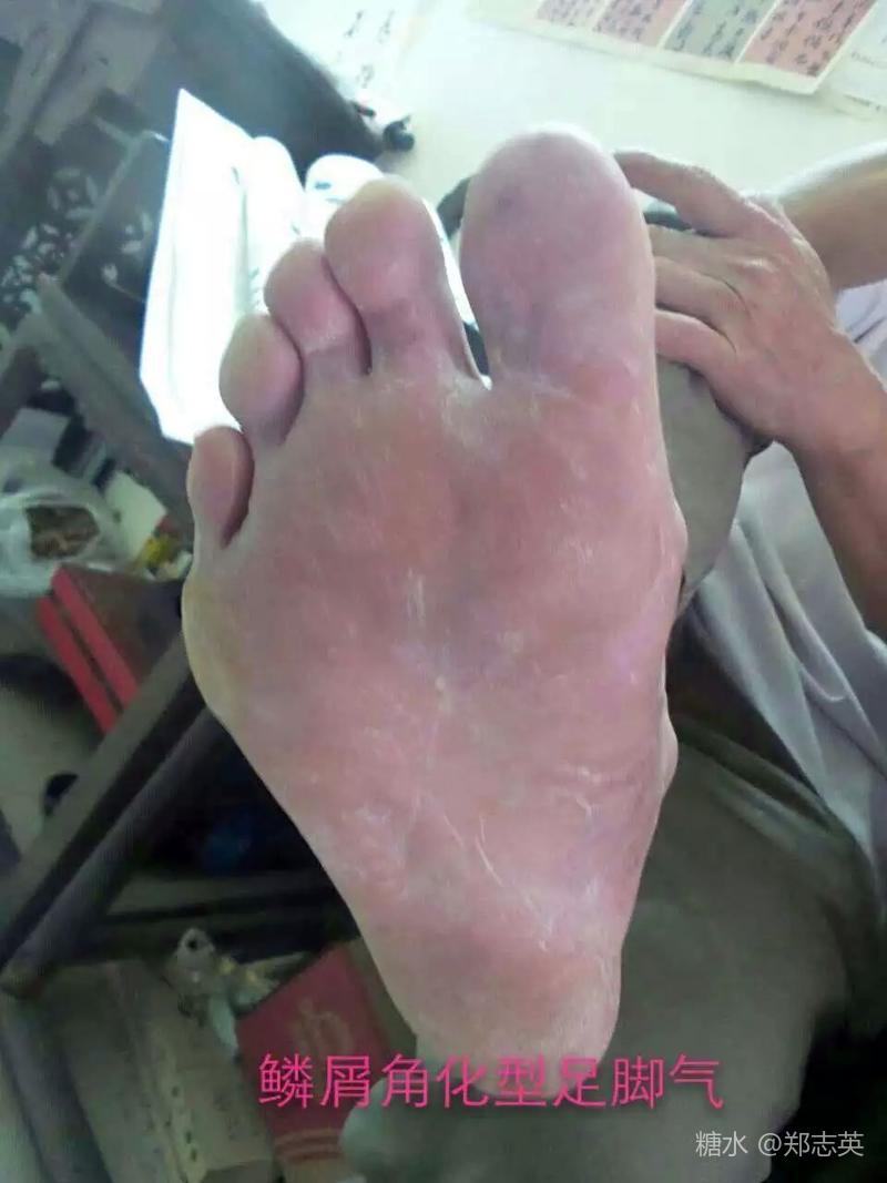 鳞屑角化型胼胝大脚趾外翻病例分析