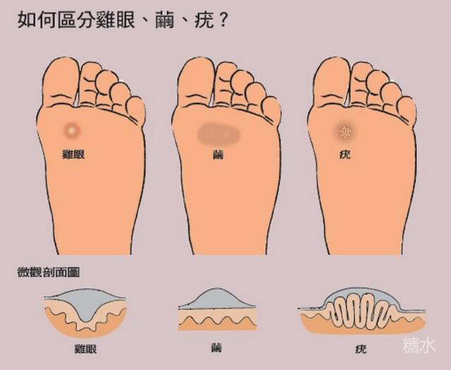 老茧 鸡眼 跖疣的区别